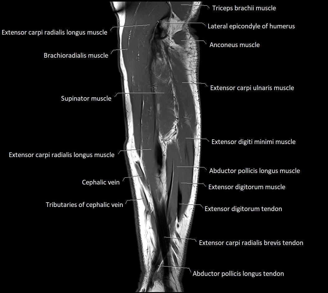 MRI 3T forearm sagittal labelled cross sectional anatomy image 13.webp